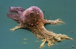 Разработан новый тест для ранней диагностики рака яичников