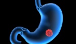 Прогностическое значение экспрессии Sox2 при раке желудочно-кишечного тракта