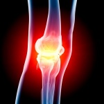 Исследование эффективности нового нехирургического метода лечения остеоартрита коленного сустава
