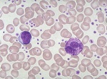 Тромбоцитоз в качестве маркера реакции на химиотерапию при тестикулярном раке