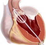 Концентрации ST2 в качестве предиктора выживаемости для пациентов, перенесших транскатетерную имплантацию аортального клапана