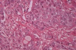 Прогностическое значение Ang-2 у больных немелкоклеточным раком легкого