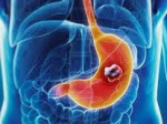 Пониженная экспрессия мРНК-485-5p является предиктором неблагоприятного исхода у больных раком желудка