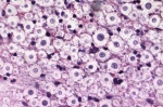 Изучен патогенез криптококкового менингита