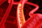 Влияние витамина D на риск  сердечно-сосудистых заболеваний