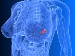 Гиперэкспрессия белка может сделать рак молочной железы более агрессивным