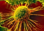 После диагностирования рака повышается риск инсульта