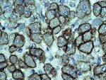Значимость мембранных белков PGP, MRP1 и MRP3 в прогнозе клинических исходов при раке яичников