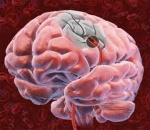 Бессимптомый атеросклероз сосудов сказывается на состоянии белого вещества головного мозга и связан со снижением умственных способностей