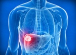 Изотопный анализ поможет диагностировать рак печени