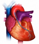 Прогностическая значимость антагониста рецептора интерлейкин-1 у пациентов с ишемической болезнью сердца