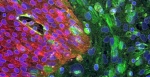 Аутологичные стволовые клетки могут помочь больным рассеянным склерозом